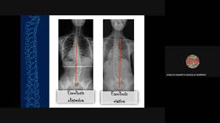 Escoliosis y espondilolistesis [upl. by Evante]