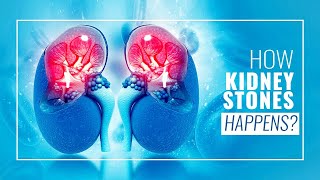 Kidney Stones 101 Everything You Wanted To Know  3D Guide [upl. by Lytsyrk]