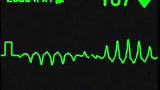 Torsades de Pointes  ECG Simulator  Arrhythmia Simulator [upl. by Nostaw503]