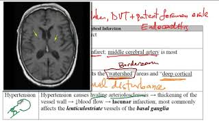 USMLE ACE Video 208 Comprehensive Guide to Ischemic Brain Stroke [upl. by Virgie895]