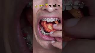 what happens when you eat spicy chips with braces [upl. by Anilam87]