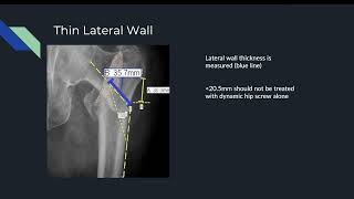 5 Intertrochanteric Femur Fractures with Marquisha [upl. by Jenei911]