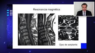 Abordaje anterior en mielopatía espondilótica cervical [upl. by Yejus]