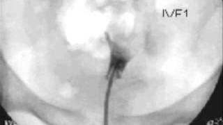 Hysterosalpingogram  HSG [upl. by Yona]