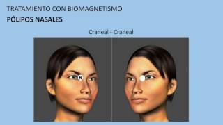 Pólipos nasales Tratamiento con biomagnetismo 16 [upl. by Zacks]