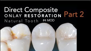 Direct Composite Onlay Part 2 Restoration  4 MOD Natural Tooth [upl. by Lennahc]