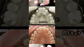 The Braces process dental orthodontics dentestry braces [upl. by Nerval677]