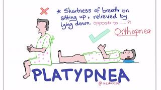 PlatypneaOrthodeoxia Syndrome [upl. by Lazaro483]