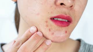 Uncover the Truth Behind Skin Spots Petechiae [upl. by Helmut]