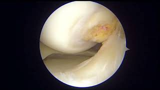 REPARACIÓN DE ROTURA DE MENISCO COMPLEJA Medial Meniscus vertical circunferential tear [upl. by Zena]