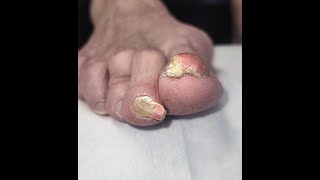 MASSIVE TRANSFORMATION with rams horn nail PINCER nail and thickened FUNGAL nail ramshorn [upl. by Atinaujnas]