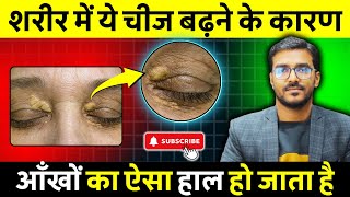 Xanthelasma  आँखों के ऊपर क्योँ चर्बी जमा हो जाती है   Homeopathic Medicine for Xanthelasma [upl. by Chiarra]