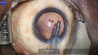 Intraoperative Zonular dialysis managed with Capsular Tension Ring CTR Dr Sheetal Brar [upl. by Deirdra]