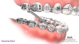 Orthodontic Treatment for Overjet Overbite  Forsus Appliance [upl. by Merry328]