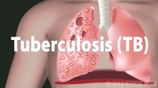 Tuberculosis TB Progression of the Disease Latent and Active Infections [upl. by Marks]