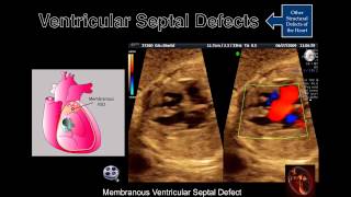 Left Ventricular Outflow Tract View [upl. by Amsirahc894]