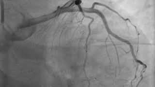 Aberrant Circumflex artery [upl. by Ecirehc]