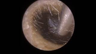 799  Armageddon Ear Wax Removal [upl. by Madelene]