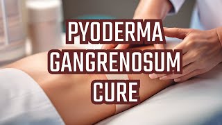 Treatment of Pyoderma gangrenosum [upl. by Aicilav]