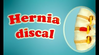 Hernia discal [upl. by Louanna]