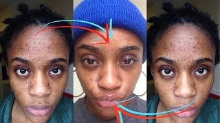 How I Got Rid of Dark Scars Hyperpigmentation amp Acne [upl. by Ahselrac339]