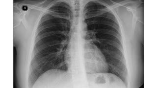 Chest xray  Asbestosis  Pleural calcifications  Round atelectasis [upl. by Nidla306]