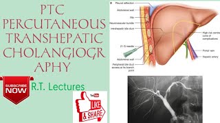 PTCPTHC PERCUTANEOUS TRANSHEPATIC CHOLANGIOGRAPHY Procedure HindiEnglish for BRT amp DRT students🥰 [upl. by Eikcin]