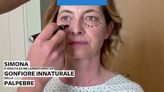 Oculoplastica  Lipofilling e blefaroplastica completa [upl. by Ettenay]