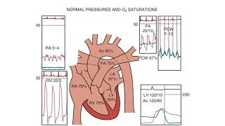 Right Heart Catheterization  an introduction [upl. by Htnamas121]