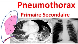 Pneumothorax spontané primitif secondaire Radiologie douleur thoracique traitement Anatomie plèvre [upl. by Cogswell]