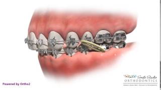 Elastics  Class II  Orthodontic Treatment [upl. by Oetomit]