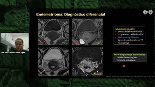 40 Encuentro académico de radiología  Tumores de células germinales [upl. by Atikram533]