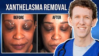 Removing Xanthelasma with Lasers  Thirzas Testimonial [upl. by Aztinaj]