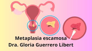 Metaplasia Escamosa en mi papanicolaou ¿Que hacer [upl. by Devehcoy]