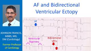 AF and Bidirectional Ventricular Ectopy [upl. by Eleirbag]