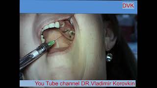 Infiltration Anesthesia for extration 232627 teeth [upl. by Calmas463]