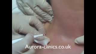 Mole Removal by Curettage [upl. by Frayda]