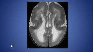 radiolgy cases lissencephaly [upl. by Awe]