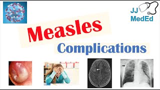 Measles Complications Immunosuppression Encephalitis SSPE etc Diagnosis Treatment Prevention [upl. by Aitra284]