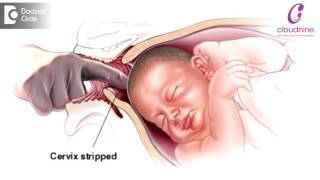 Methods of Labour Induction  Dr Padmini Isaac  Cloudnine Hospitals [upl. by Allevon385]