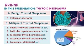 Thyroid neoplasmsTumors  شرح محاضرة [upl. by Goldstein]