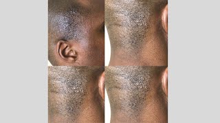 Getting Rid of Razor Bumps on a Bald Head [upl. by Neuberger]