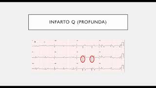 ELECTROCARDIOGRAFÍA CLÍNICA Síndrome Coronario Agudo Infarto Agudo de Miocardio PARTE 3 [upl. by Min739]