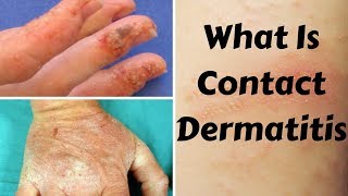 What Is Contact Dermatitis [upl. by Bauske]