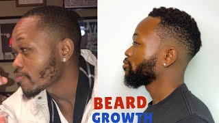 HOW I GREW MY BEARD USING MINOXIDIL  GET RID OF PATCHY BEARD [upl. by Okire88]