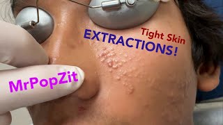 Tight skin acne extractions Comedonal acne with some inflammatory nodules Great session must see [upl. by Sirahs]