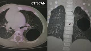 CPAM Congenital Pulmonary Airway Malformation [upl. by Sachsse580]