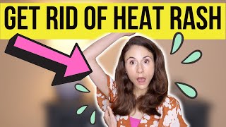 HOW TO GET RID OF HEAT RASH FAST Dermatologist DrDrayzday [upl. by Samale]