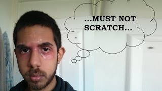 How to NOT Scratch Eczema  Dermatitis  Psoriasis [upl. by Lrae406]