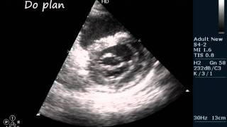 MSMR RHD ECHOCARDIOGRAPHY SERIES BY DRANKURKCHAUDHARI [upl. by Ehsom]